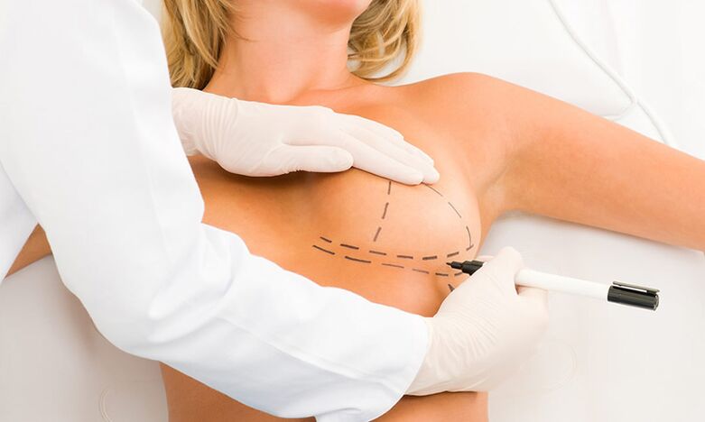 Mammoplasty -breast σήμανση