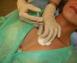 Εισαγωγή ενός meso-cocktail στον ιστό του μαστού – μια εναλλακτική λύση στις ενέσεις υαλουρονικού οξέος