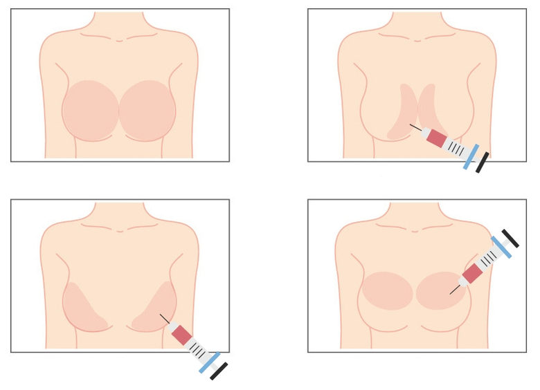 Τοποθεσίες για την ένεση υαλουρονικού οξέος στο στήθος